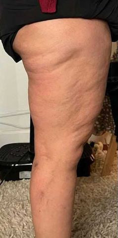 LeggCurve® | Leggings de Drenaje Linfático Anti-Celulitis 3D