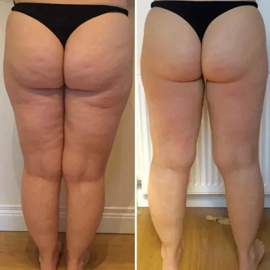 Anti-Cellulite® | Aceite de Masaje Natural MX (100ml)